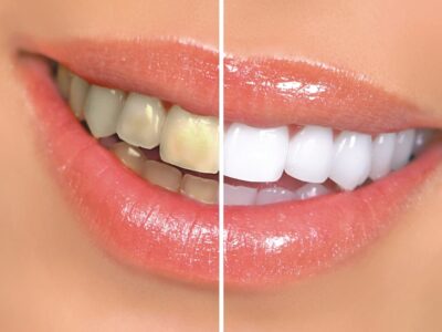 Ottawa teeth whitening