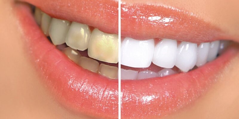 Ottawa teeth whitening