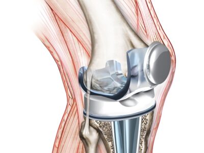 Knee Replacement