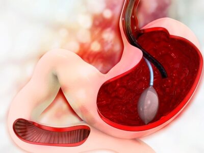 Gastric Balloon