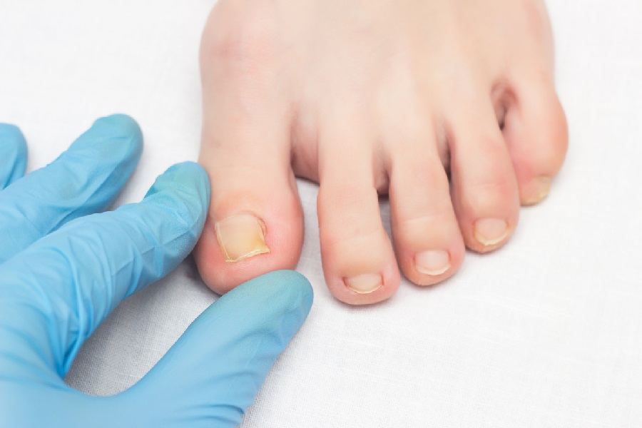 Ingrown Toenail and Reasons To Avoid It Health Trumpet