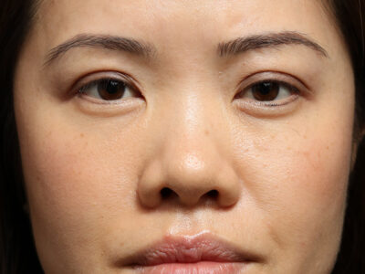 Asian Rhinoplasty in New York