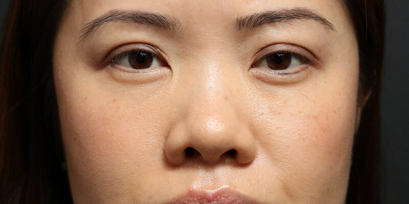 Asian Rhinoplasty in New York